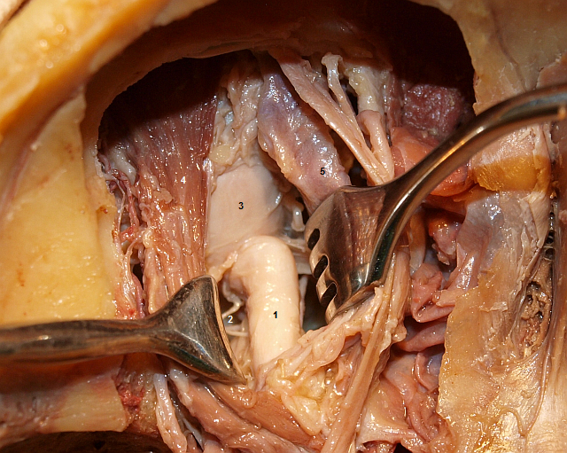 Left eyeball and optic nerve
