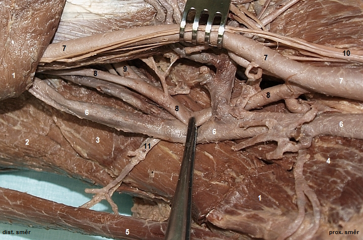 Fossa iliopectinea (m. adductor longus odklopen)
