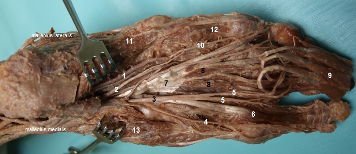 Cvy a nervy v plant (m. flexor digitorum brevis odklopen)